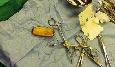 Doctors realized the patient had swallowed a small phone.